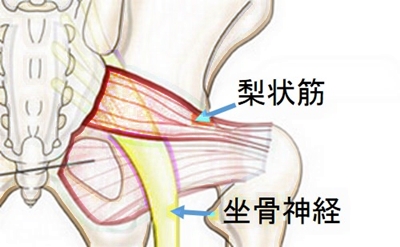 梨状筋症候群