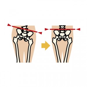 骨盤のズレと坐骨神経痛
